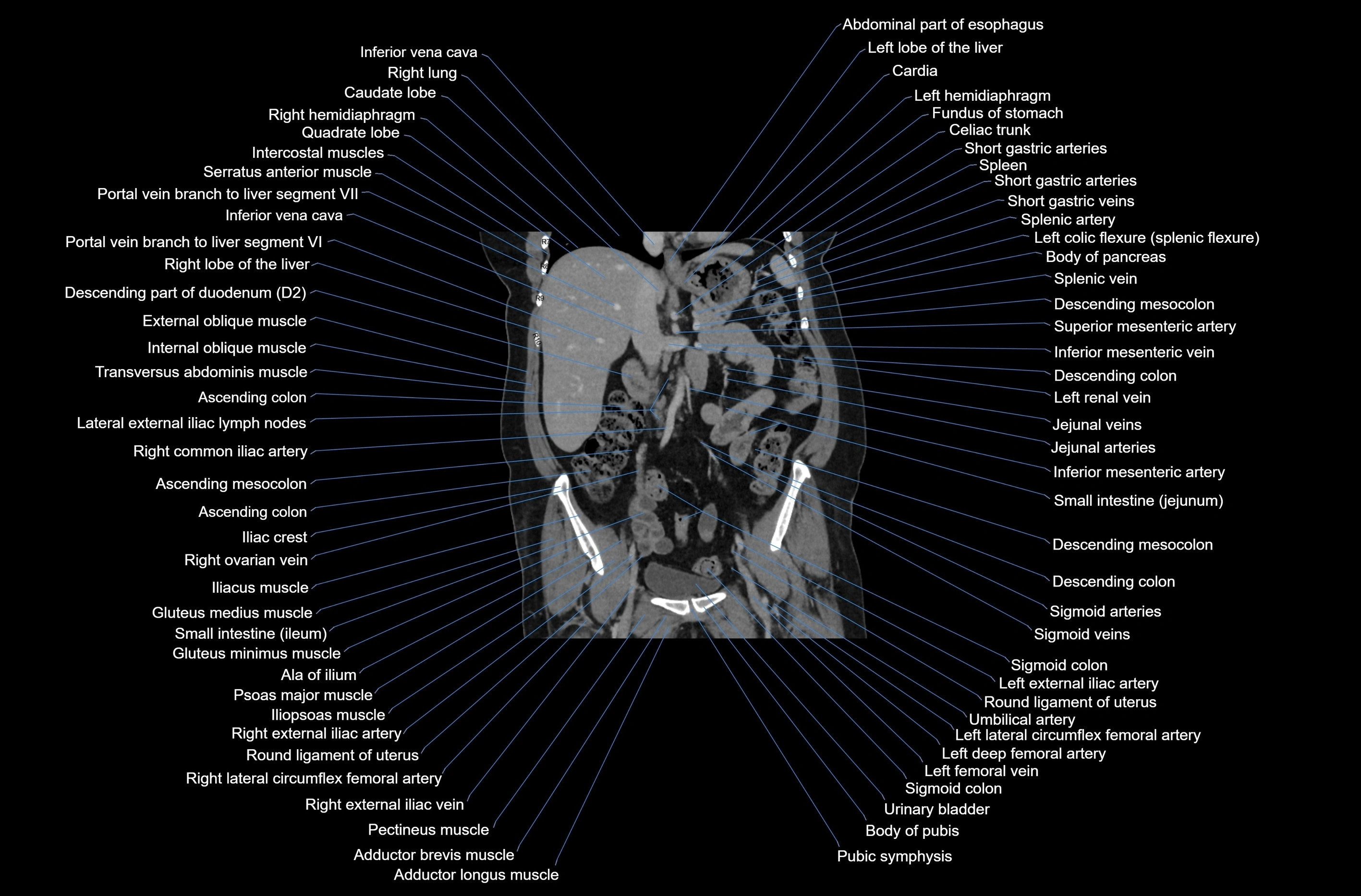 CT abdomen coronal cross sectional anatomy labelled radiology image-00043.webp